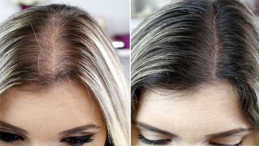 Imecap Hair antes e depois